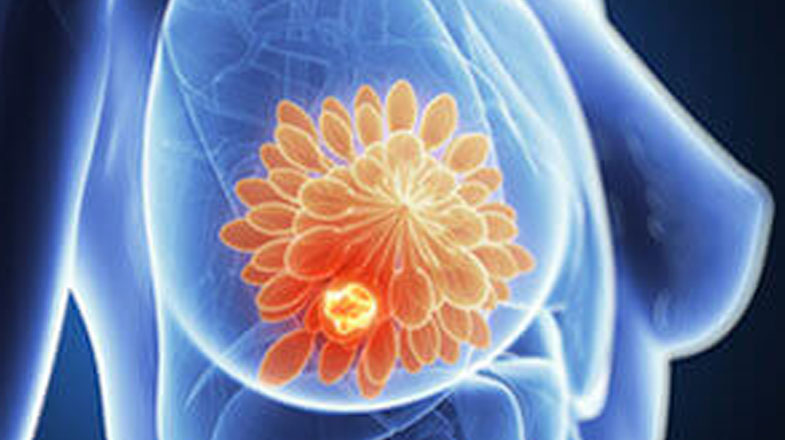 breast_cancer_original300x170.jpg