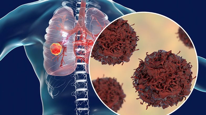 Lung Cancer: The Facts