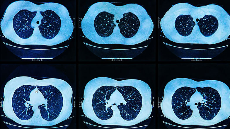 mri_scan_of_the_human_lungs.376x306.jpg
