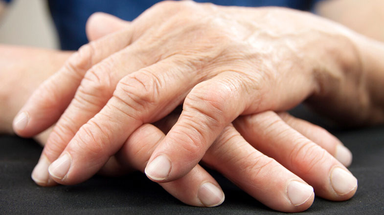Rheumatoid Arthritis - More Than a Joint Disease