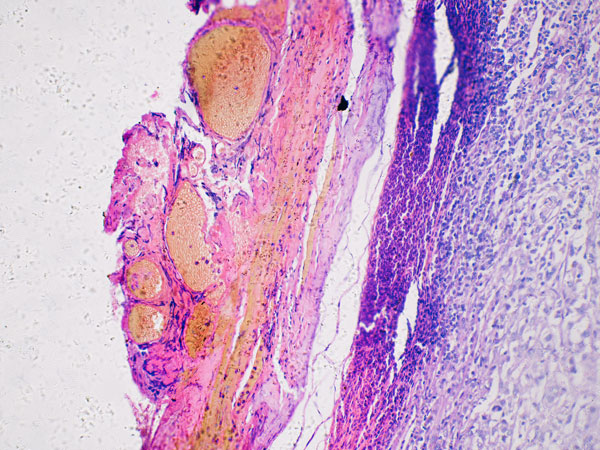 What Causes Melanoma