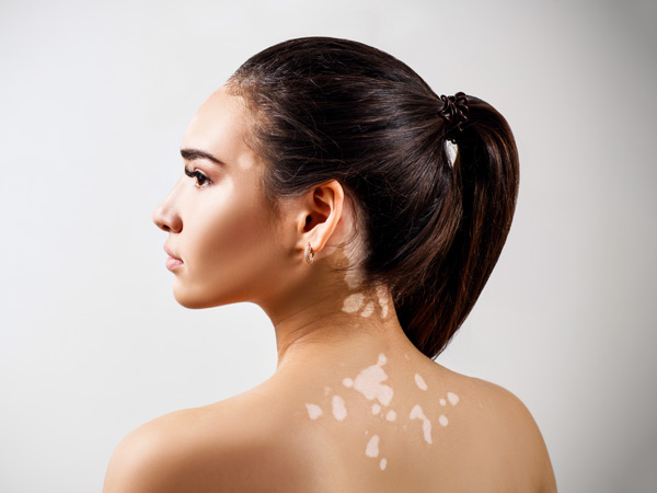 Vitiligo Symptoms