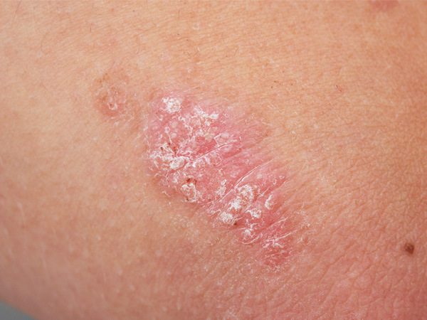 Plaque Psoriasis: What It Looks Like, Causes & Treatment