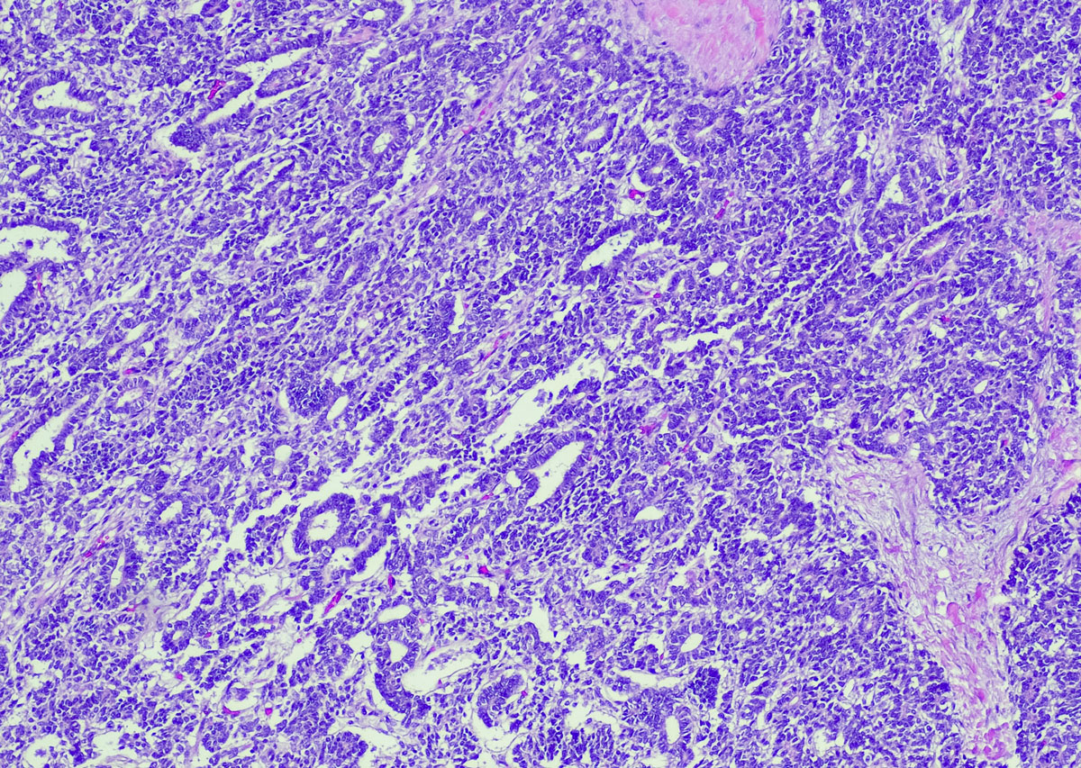 image of sarcoidosis