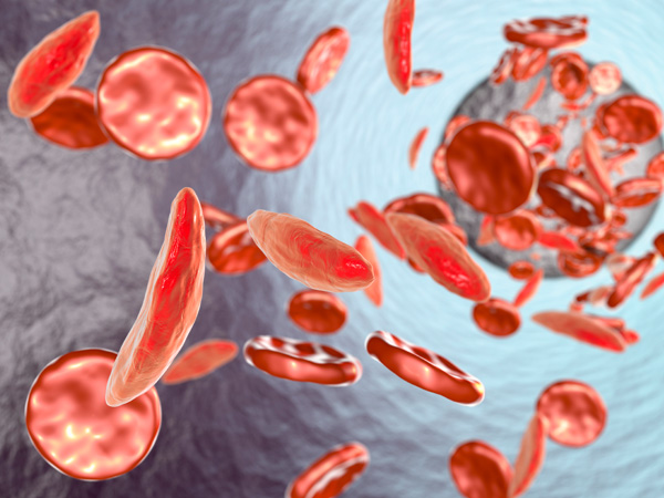 What Causes Sickle Cell Anemia