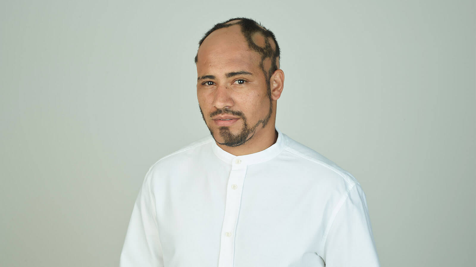 Man with Alopecia Areata