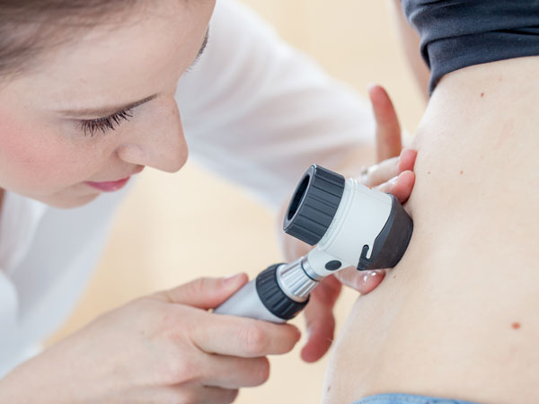 Melanoma Signs and Symptoms
