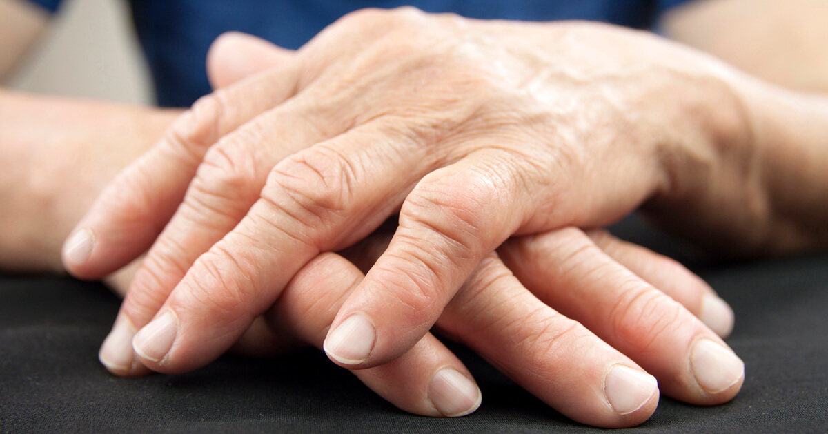 Rheumatoid Arthritis - More Than a Joint Disease
