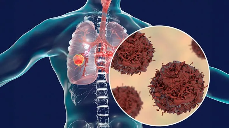 Medical graphic of a human chest with magnified lung tumor cells in a circular inset thumbnail