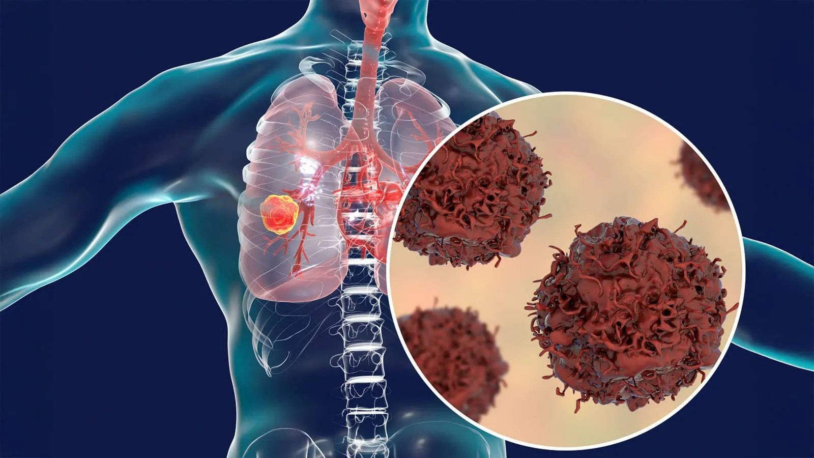 Medical graphic of a human chest with magnified lung tumor cells in a circular inset