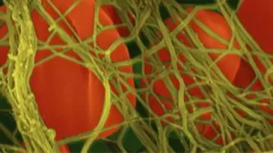hemophilia