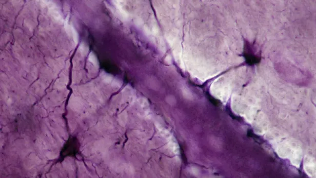 Seizing upon a ‘Special Sauce’ of Drug Development to Fight Cancer in the Brain