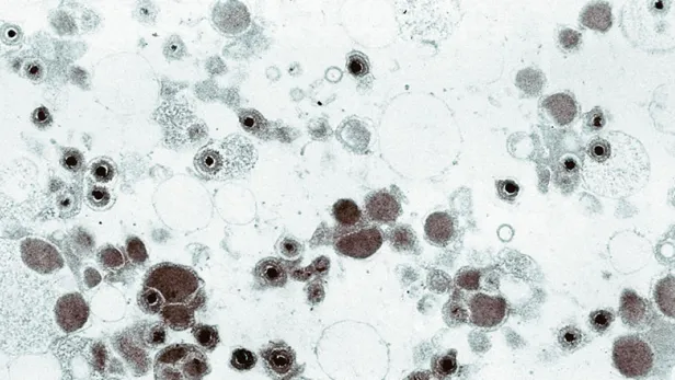 Advances in Cytomegalovirus Vaccine Development