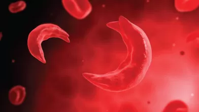 Sickle Cell Trait vs. Sickle Cell Disease