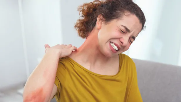 Eczema: More Than Just a Skin Condition