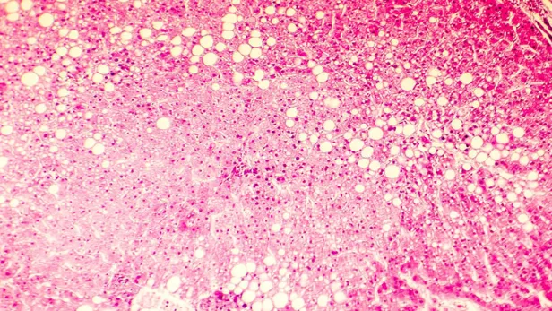 light_micrograph_of_a_fatty_liver_376x306.jpg
