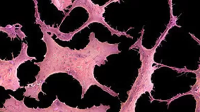 Using ‘Omics to Understand the Rise in Breast Cancers Among Young Asians