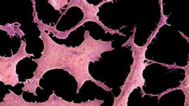 Using ‘Omics to Understand the Rise in Breast Cancers Among Young Asians