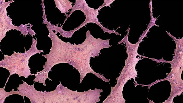 Breast Cancer Cells