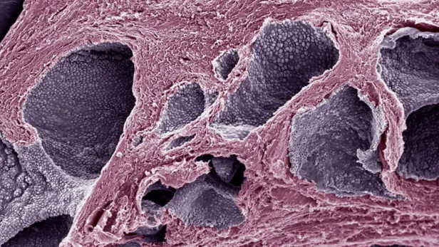 Prostate cancer cell