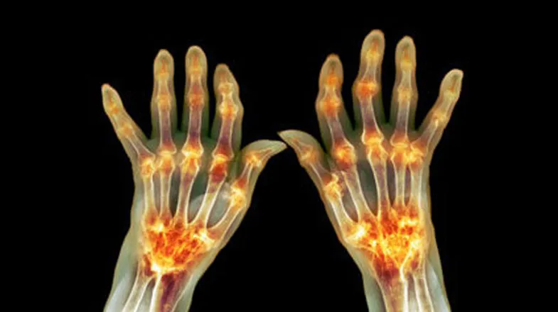  inflammation_785X440.jpg 