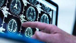 Survey Demonstrates the Need for More Effective Policy Responses to Prevent Stroke in Europe