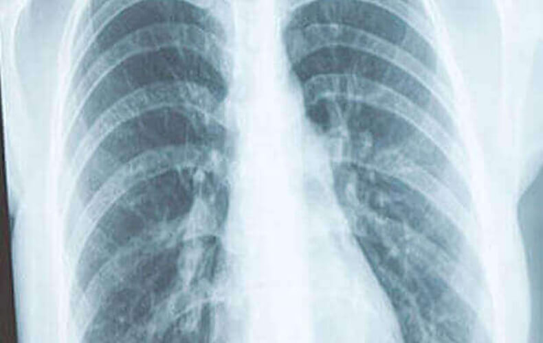 Pulmonary Hypertension Tile